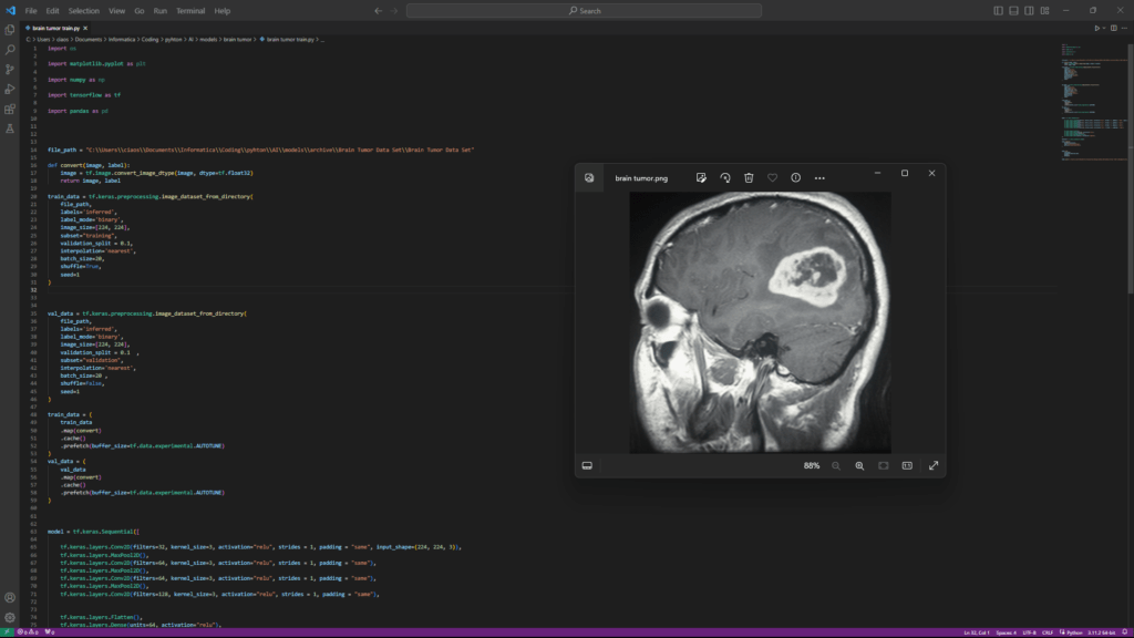 Python code of an artificial intelligence that diagnose cancer tumor and a photo of a carcinogenic brain